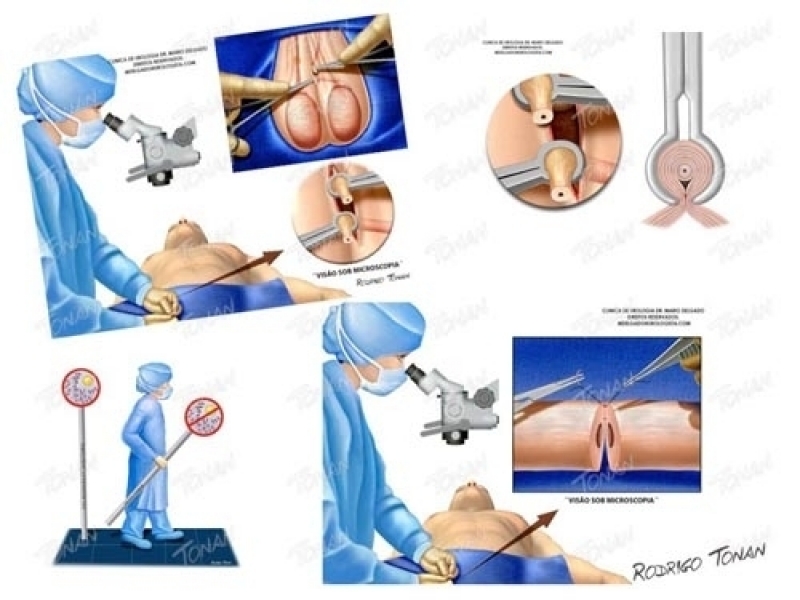 Clínica para Cirurgia Fimose Parcial Penha de França - Cirurgia para Tirar Fimose