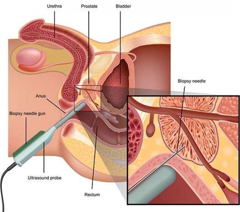 biopsia prostata prostatita și cum să o faceți
