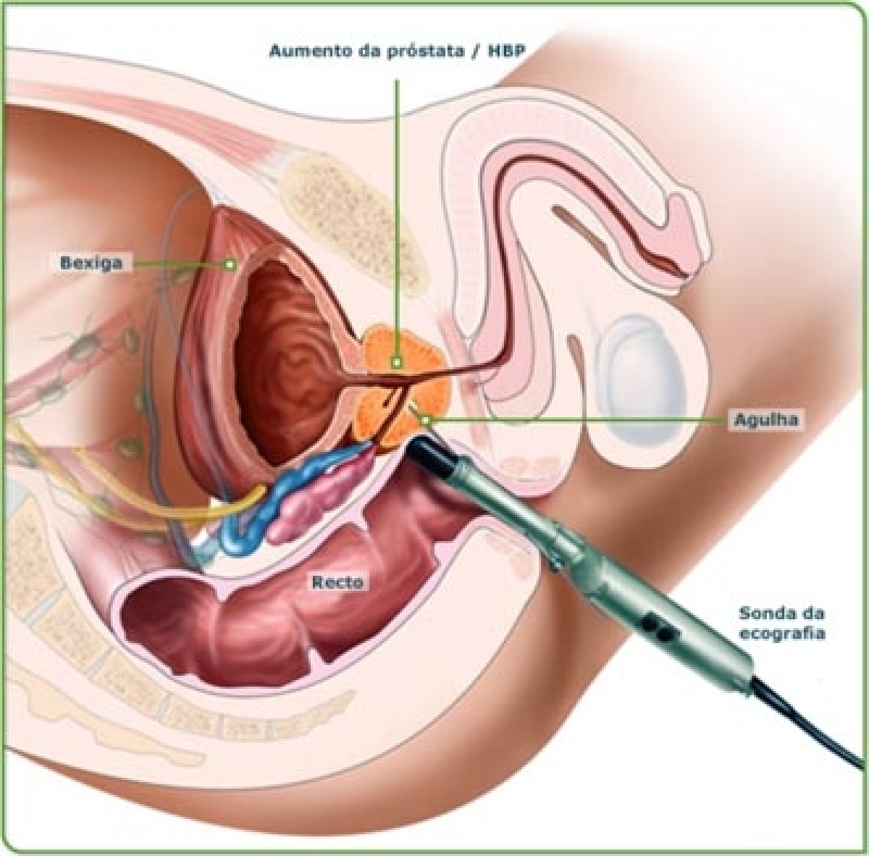 Onde Encontrar Biópsia Prostática Transretal em Artur Alvim - Ultrassonografia de Próstata