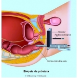 biopsia para câncer de próstata na Mooca