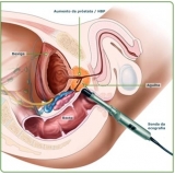 biopsia para detectar câncer de próstata na Mooca