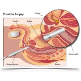biopsia de próstata