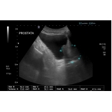 ultrassonografia de próstata
