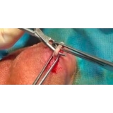 cirurgia de fimose a laser Piqueri