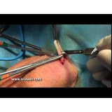 cirurgia de vasectomia em SP em Aricanduva