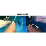 clínica para vasectomia na Vila Curuçá