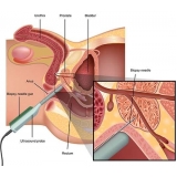 postectomia parcial Água Rasa