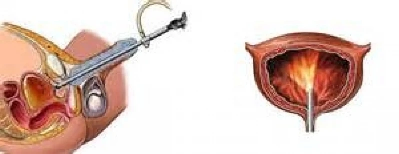 biopsia de próstata com sedação