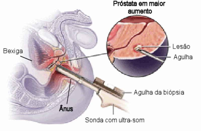 biópsia prostática de saturação
