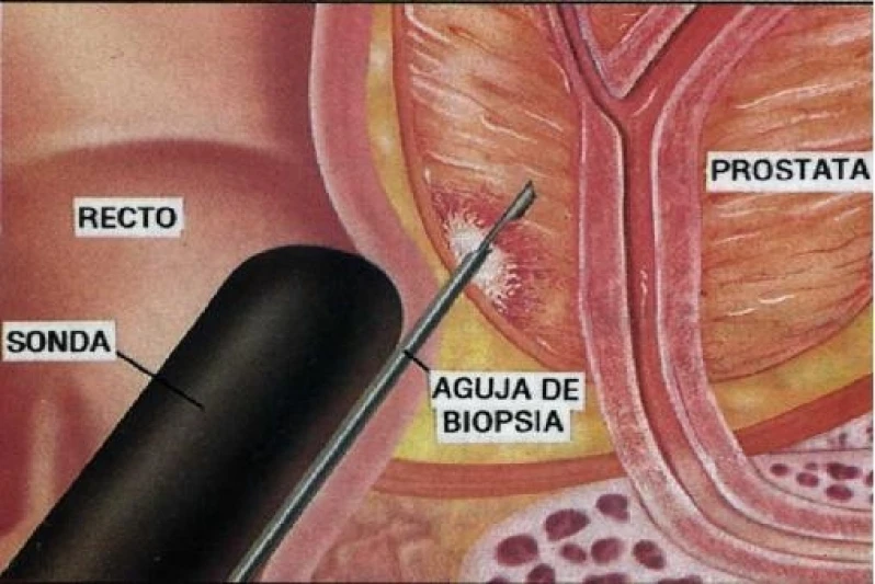 biópsia prostática transretal