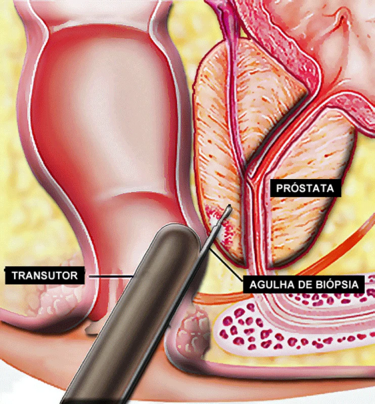 biopsia prostática