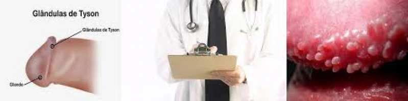 cauterização de lesão peniana