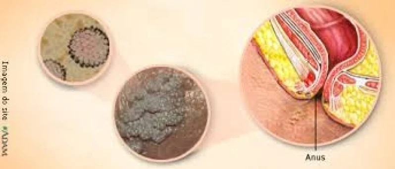 cauterização peniana