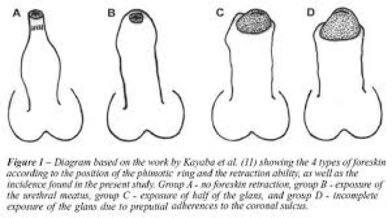 cirurgia de fimose infantil