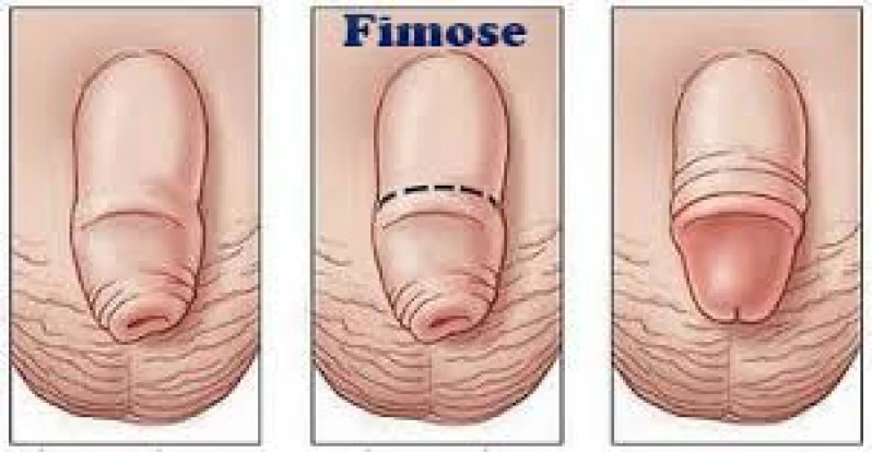 cirurgia de postectomia