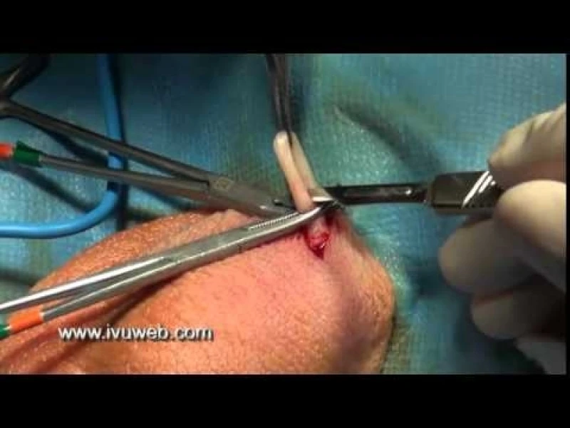 cirurgia de vasectomia em sp