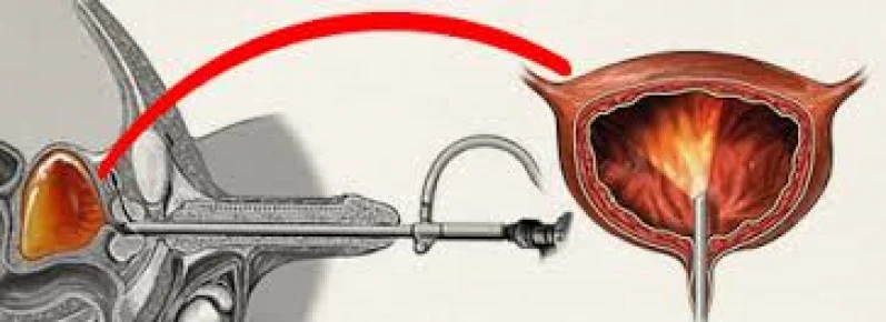 cistoscopia de próstata