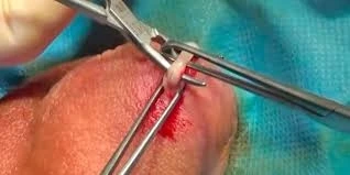 clínica para reversão de vasectomia