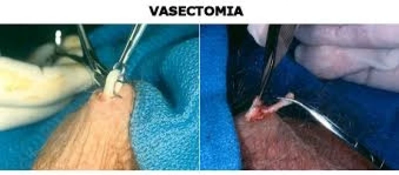 clínica para vasectomia