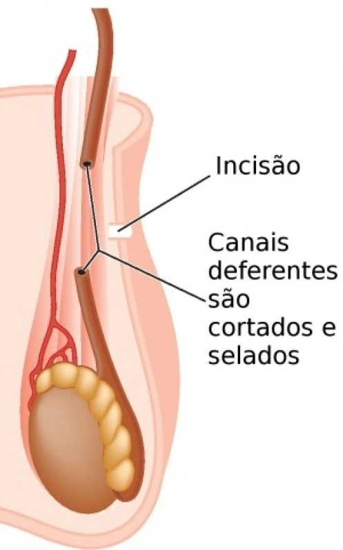 médico para vasectomia