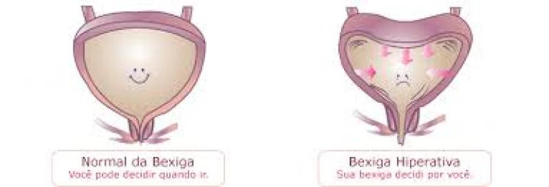 tratamento para bexiga hiperativa