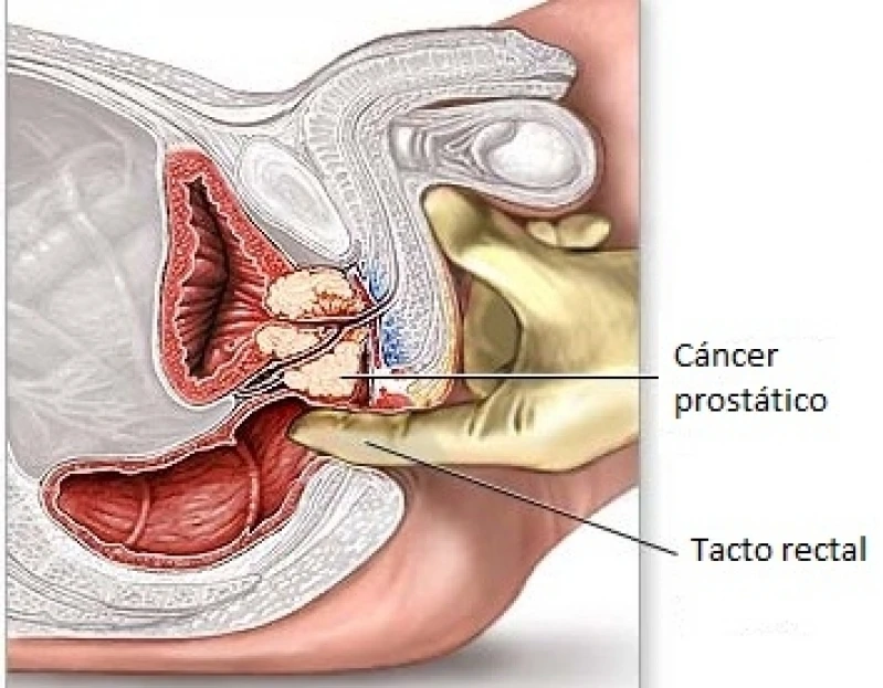 tratamento urológico
