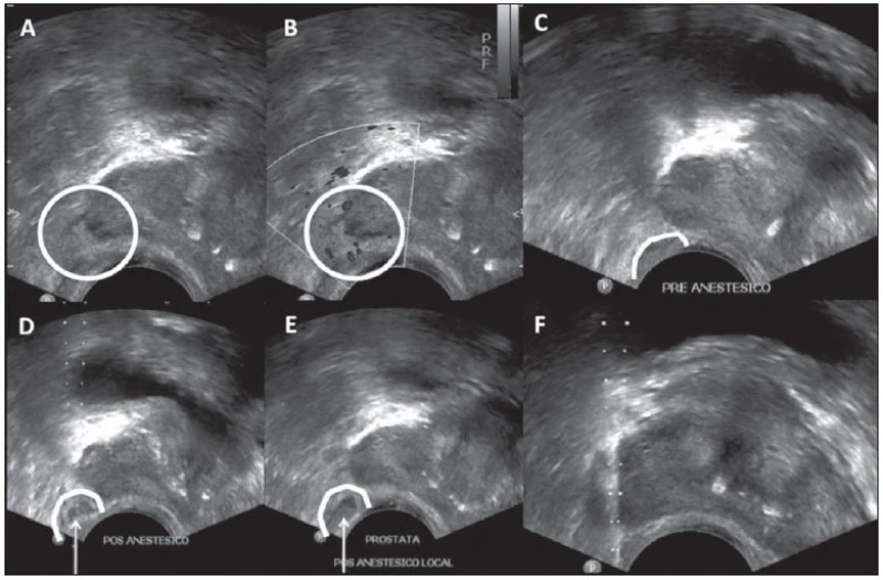 ultrassonografia de próstata