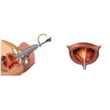 biopsia de próstata com sedação no Tatuapé