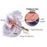 biopsia de próstata em Guaianases