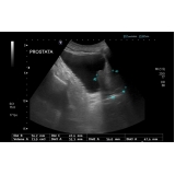 biopsias-de-prostatas-avaliacao-urodinamica-avaliacao-urodinamica-em-maua