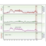 biopsias para detectar câncer de próstata na Cidade Patriarca