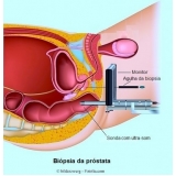 cirurgia de postectomia laser Diadema cirurgia de postectomia laser Diadema