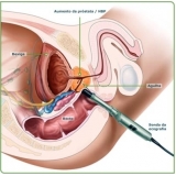 cirurgia de postectomia para hpv Mooca cirurgia de postectomia para hpv Mooca