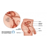 cirurgia fimose parcial Anália Franco cirurgia fimose parcial Anália Franco