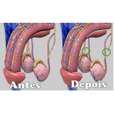 cirurgia para tirar a fimose Piqueri cirurgia para tirar a fimose Piqueri