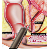 cirurgias-de-postectomia-cirurgia-de-fimose-postectomia-cirurgia-de-postectomia-adulto-tatuape