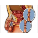 clínica de cirurgia de fimose a laser Tatuapé clínica de cirurgia de fimose a laser Tatuapé