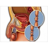 onde encontrar cirurgia de vasectomia em Santo André onde encontrar cirurgia de vasectomia em Santo André