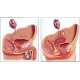 tratamento-urologico-biopsia-peniana-cirurgia-para-fimose-em-diadema