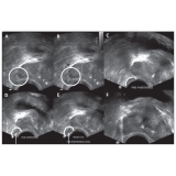 quanto custa biopsia prostática ecoguiada na Vila Dalila