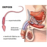 quanto custa cirurgia de vasectomia em José Bonifácio quanto custa cirurgia de vasectomia em José Bonifácio