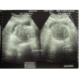 quanto custa ultrassonografia de próstata na Cidade Patriarca