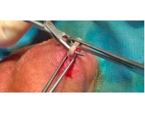 vasectomia-cirurgia-de-vasectomia-em-sao-paulo-cirurgia-de-vasectomia-em-sao-paulo-em-agua-rasa
