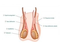 vasectomia-cirurgia-de-vasectomia-em-sao-paulo-cirurgia-de-vasectomia-na-cidade-lider