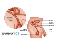 vasectomia-cirurgia-de-vasectomia-em-sao-paulo-cirurgia-de-vasectomia-em-sao-paulo-no-jardim-iguatemi