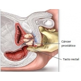 tratamento-urologico-biopsia-peniana-cirurgia-de-postectomia-infantil-em-santo-andre