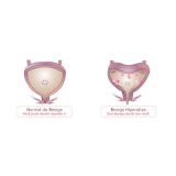 tratamento para bexiga hiperativa no Tatuapé tratamento para bexiga hiperativa no Tatuapé