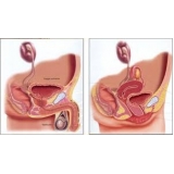 tratamento para incontinência urinaria em Diadema tratamento para incontinência urinaria em Diadema