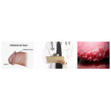 tratamento-urologico-biopsia-peniana-cirurgia-de-postectomia-em-artur-alvim