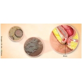 tratamento-urologico-biopsia-peniana-cauterizacao-de-lesao-peniana-em-sao-caetano-do-sul